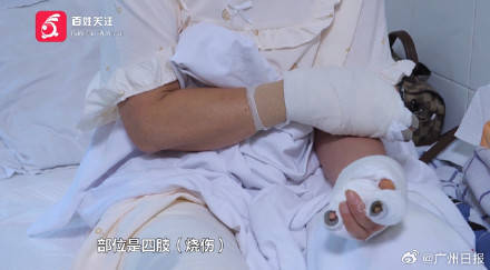 皇冠信用网注册_女子水中捡漂亮石头装裤兜里被烧伤皇冠信用网注册，医生：“石头”初步判定是磷