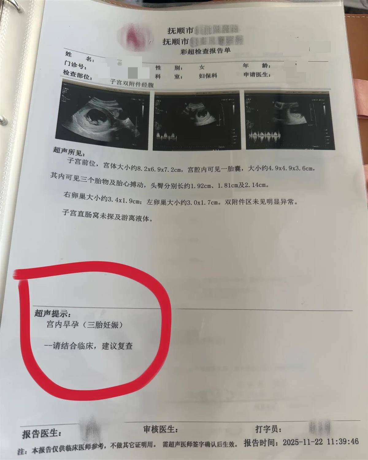皇冠足球平台_辽宁一孕妇两个月内从一胎变四胞胎皇冠足球平台，每次产检发现多出一胎，医生：系同卵四胞胎，概率1300万至1500万分之一
