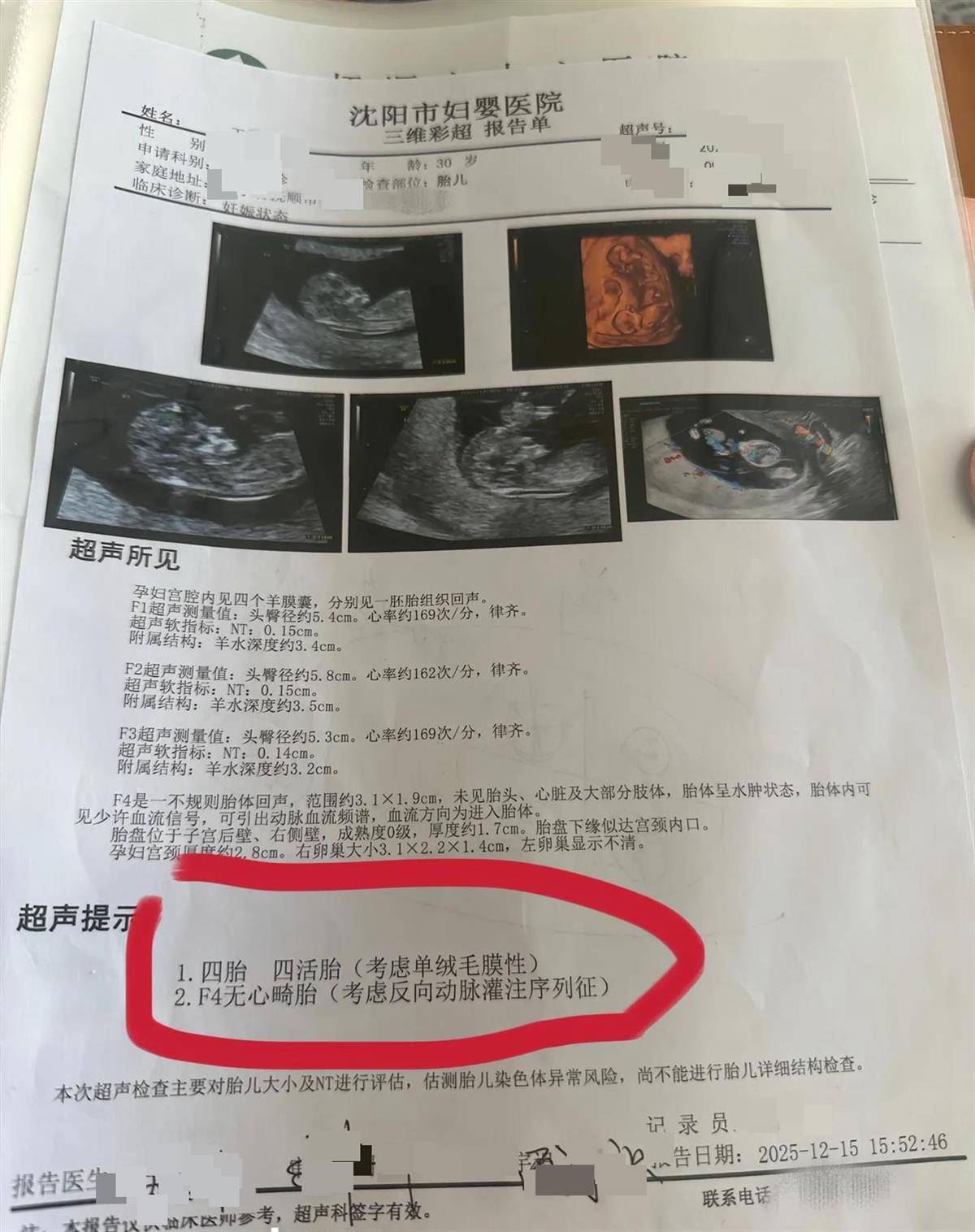 皇冠足球平台_辽宁一孕妇两个月内从一胎变四胞胎皇冠足球平台，每次产检发现多出一胎，医生：系同卵四胞胎，概率1300万至1500万分之一