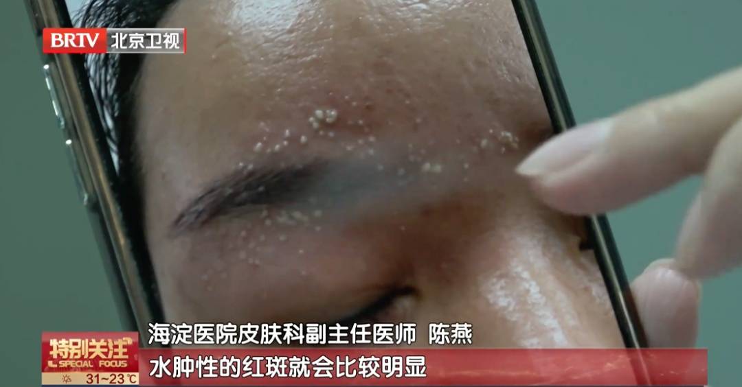 皇冠信用
_北京已有人中招皇冠信用
,千万不能拍,毒液堪比硫酸,会毁容——